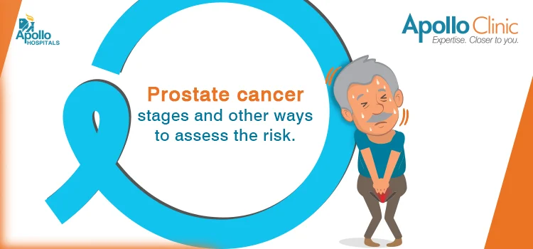 Prostate Cancer Stages And Other Ways To Assess The Risk