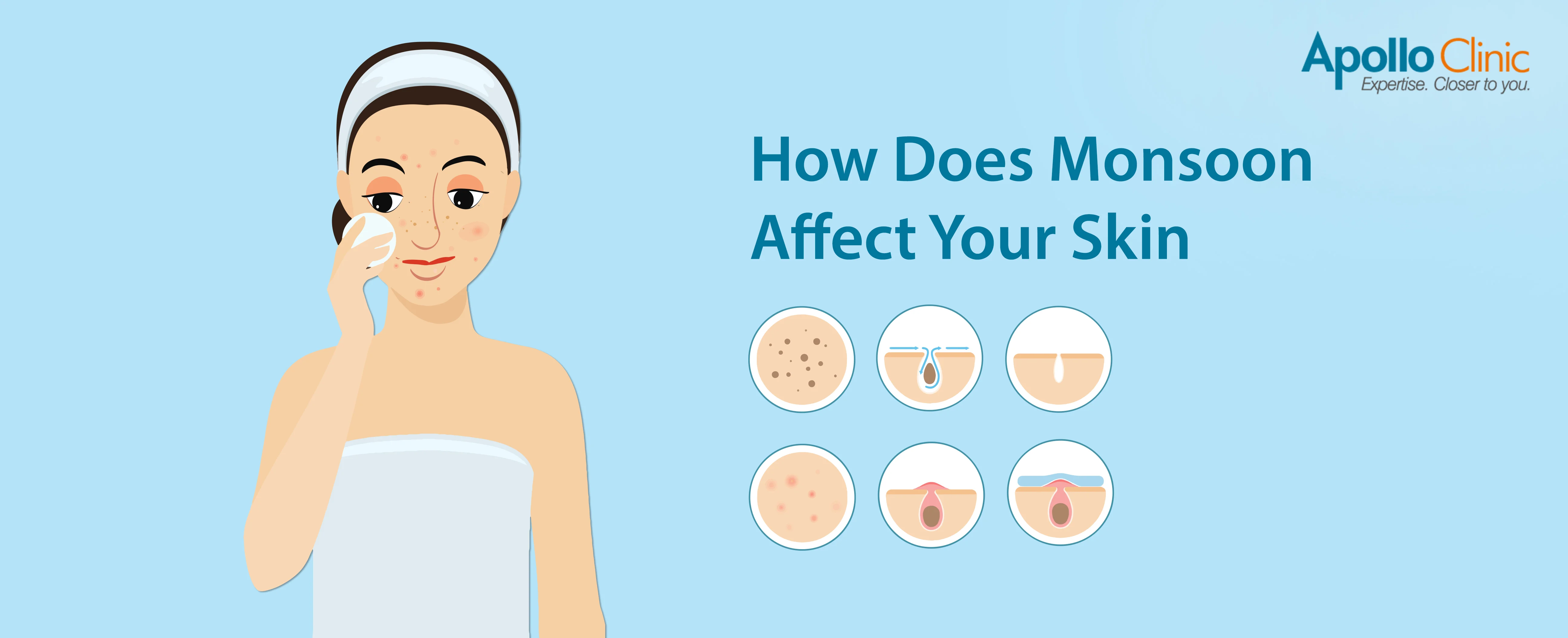 How Does Monsoon Affect Your Skin